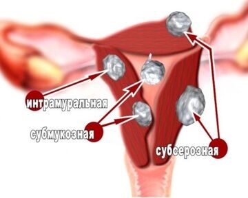 hysteromyoma_миома матки