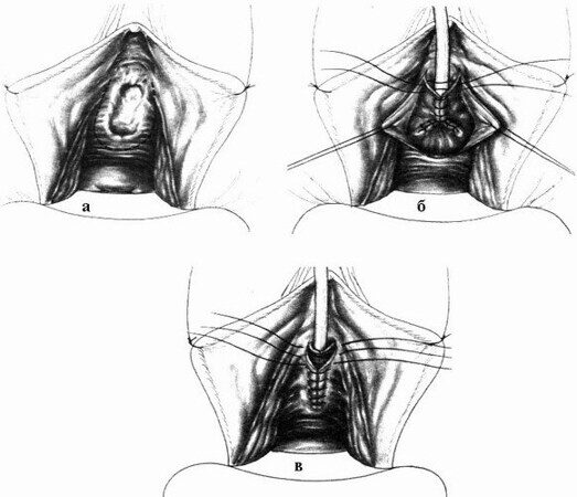 Хирургия женской уретры | arakani.ru — Урологический информационный портал!