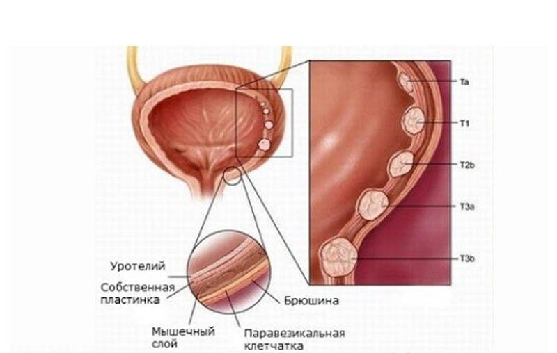 leykoplakiya-mochevogo-puzyrya